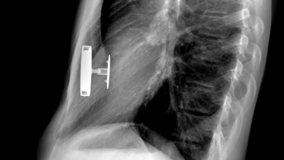 May Pull Kids With Sunken Chests Out Of Operating Room WGBH News